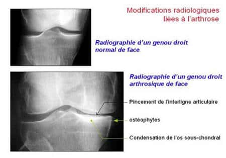 Observation d'un genou arthrosique grâce à la radiographie.<br>Source : <a target="_blank" href="http://www.rhumatologie.asso.fr/">Société Française de Rhumatologie</a> 
