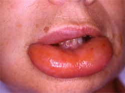 L'œdème de Quincke est caractérisé par un gonflement très marqué, localisé sur la face, les paupières et les lèvres, comme sur cette photo. © CHU Rouen