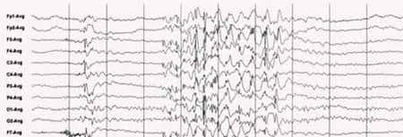 EEG d'une crise d'épilepsie généralisée. © <a href="http://lecerveau.mcgill.ca/" target="_blank">lecerveau.mcgill.ca</a> 