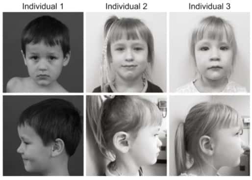 Les trois enfants examinés dans l'étude présentaient des symptômes similaires, bien qu'avec de légères variations. Ils avaient également des yeux en amande, une arête nasale « déprimée » et un arc de Cupidon proéminent sur la lèvre supérieure. © Morimoto, M., Bhambhani, V., Gazzaz, N. <em>et al.</em> 2023