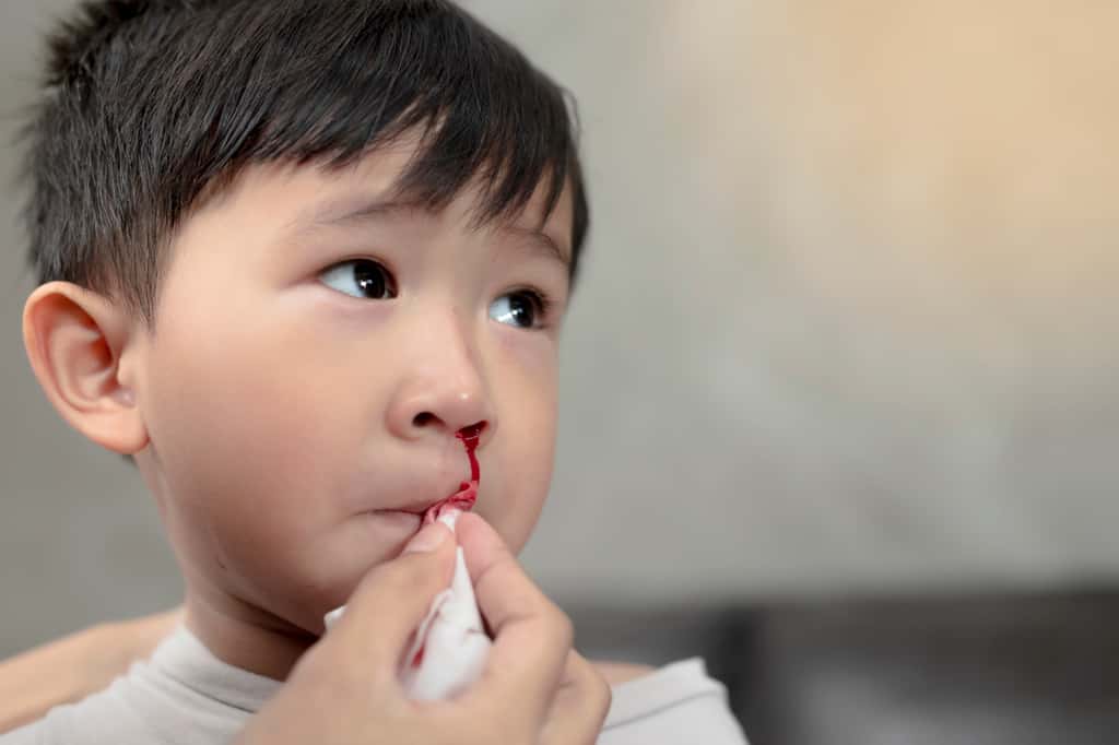 L'épitaxis, ou saignement de nez, est très courante durant l'enfance et sans gravité. © Patcharin Adobe Stock
