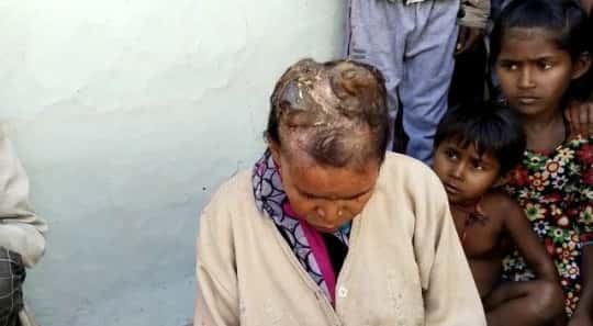 Des cornes douloureuses poussent sur sa tête depuis trois ans. Aucun médecin n'est parvenu à la soigner. © Aarti Verma, SWNS