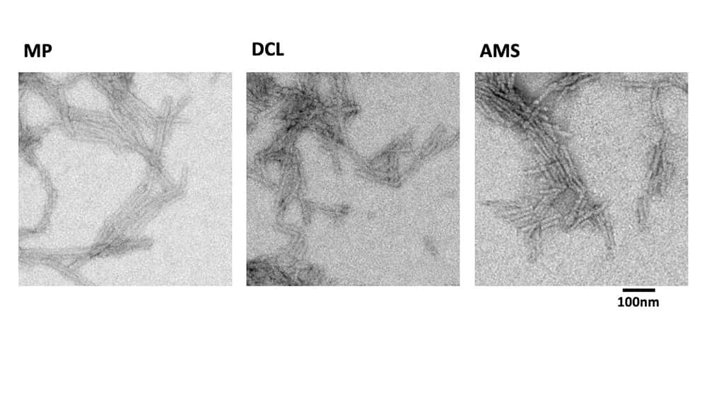Les différents agrégats de synucléine dans le cerveau typique des maladies de Parkinson (MP), de la démence à corps de Lewy (DCL) et l'atrophie multisystématisée (AMS). Ces trois maladies appartiennent à la famille des synucléinopathies. © Louis Bousset, CNRS