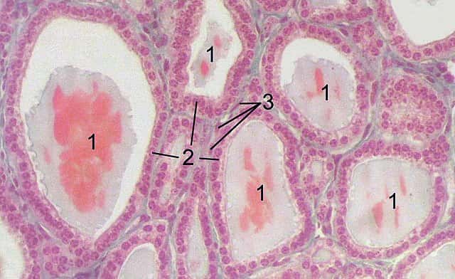  Coupe histologique du tissu thyroïdien montrant les follicules (1), les cellules folliculaires (2) et épithéliales (3). © Uwe Gille, Wikipédia Commons by-sa 3.0