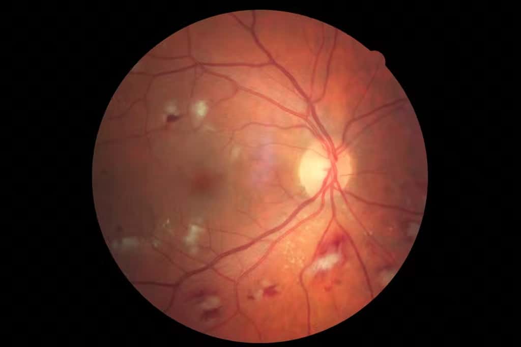 Complications vasculaires et métaboliques du diabète visibles au fond d’œil (hémorragies, exsudats). © Langis Michaud