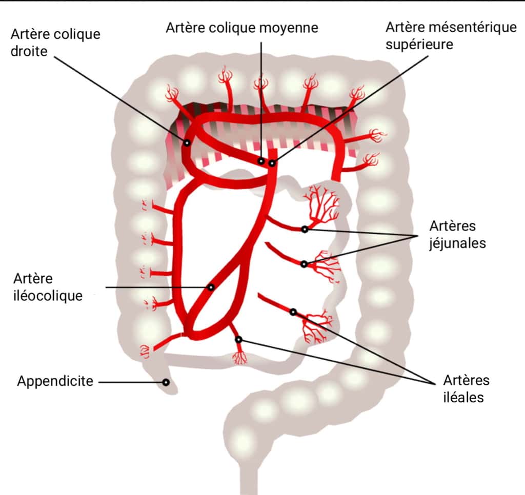 L’ischémie intestinale est une obstruction d’une veine ou d’une artère de l’intestin par un caillot sanguin ou une plaque d’athérome. © Céline Deluzarche, Futura, d’après <em>BMJ</em>.