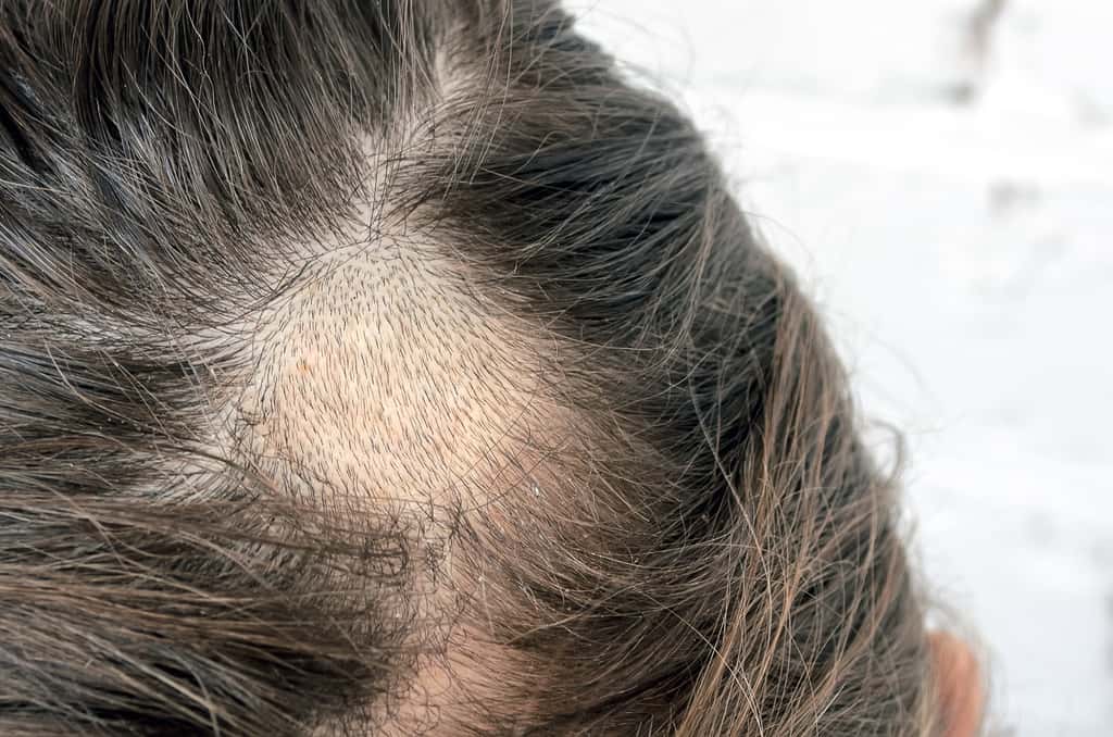 La teigne se manifeste par des plaques d’alopécie où le cheveu est court et cassant. © aneriksson - Fotoli