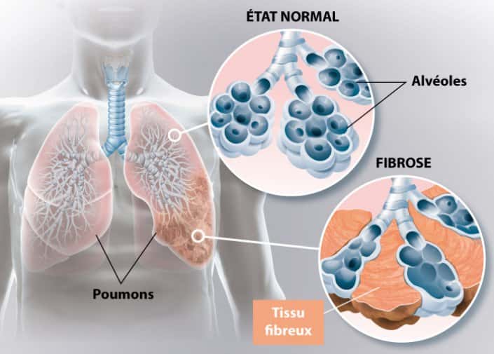 La fibrose pulmonaire est liée à la formation de tissu fibreux cicatriciel dans les poumons. © <a href="https://ramsaygds.fr/vous-etes-patient-en-savoir-plus-sur-ma-pathologie/fibrose-pulmonaire" target="_blank">Ramsay Santé</a>