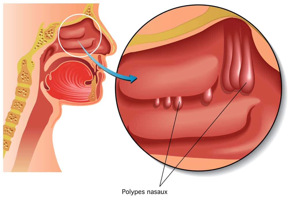 La polypose naso-sinusienne est due aux développement de polypes en « goutte d’eau » sur les muqueuses nasales et les sinus. © rob3000, Adobe Stock