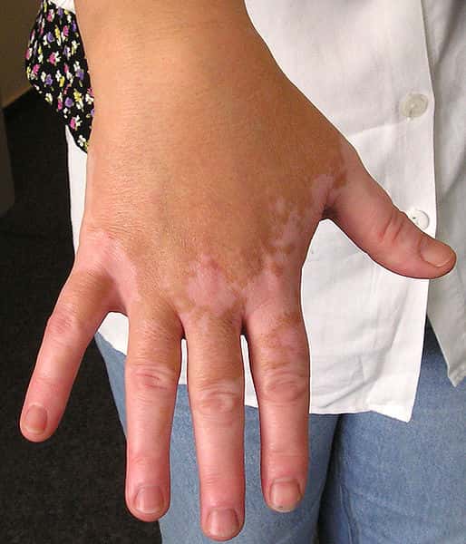 Plaques de peau dépigmentées, dues au vitiligo. © CC by-nc-sa 3.0