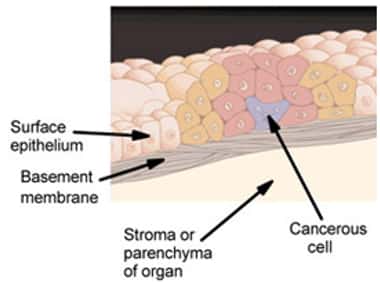 Le cancer in situ se limite à un seul tissu, comme l'illustre ce schéma. La cellule cancéreuse (cancerous cell) va se multiplier dans un tissu épithélial (surface epithelium). Plus tard, ces cellules pourront alors traverser la membrane basale (basement membrane) et coloniser le tissu voisin dans le même organe (stroma or parenchyma of organ). © National Cancer Institute, Wikipédia, DP