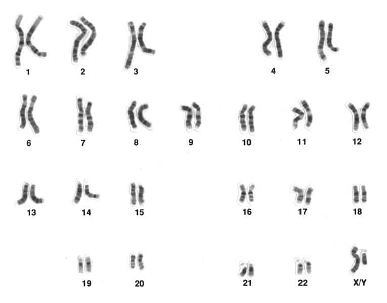 Un caryotype humain normal avec ces 22 autosomes et sa paire de gonosome, ici XY. © DR
