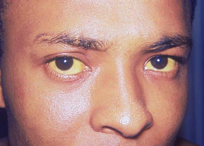 Une personne atteinte de jaunisse dont la couleur des yeux est caractéristique. © Thomas F. Sellers, <em>Emory University</em>, DP 