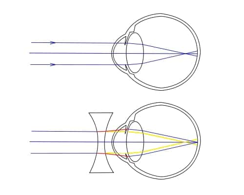 Ce schéma illustre les problèmes rencontrés par les personnes myopes. Dans l'image du haut, les rayons venant de l'infini convergent en un point situé en avant de la rétine, qui tapisse le fond de l'œil : la personne est myope. Grâce à une lentille divergente, placée devant l'œil dans la seconde image, le cristallin fait converger les rayons en un point situé précisément au niveau de la rétine. Le tracé avant correction est représenté en jaune. © A. Baris Toprak, Wikipédia, cc sa 1.0