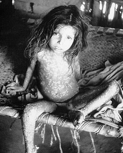 La variole est une maladie virale qui a pu être éradiquée grâce aux campagnes de vaccination. © DR