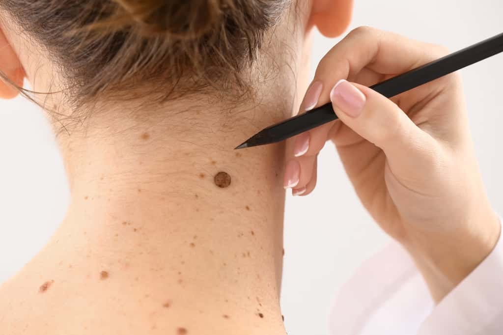 Consultez régulièrement un dermatologue pour suivre l’évolution de tous vos grains de beauté ou autres tâches. © Pixel-Shot, Adobe Stock