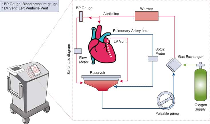 La technique du  « cœur dans une boîte » nouvellement réalisée par des chercheurs de Stanford. © Krishnan, Woo <em>et al.</em> 2023