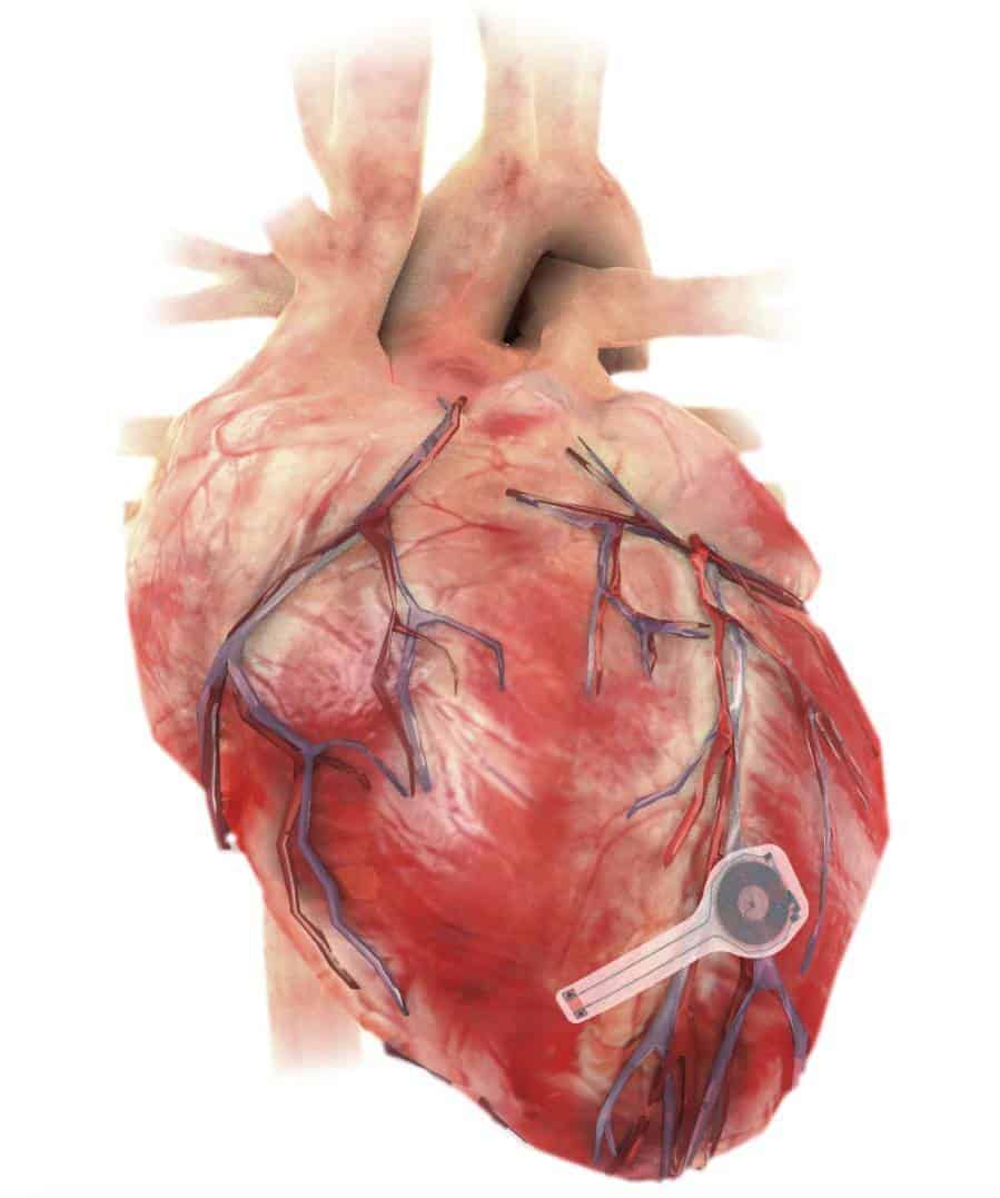 Le pacemaker transitoire placé sur le cœur. © <em>Northwestern University</em>