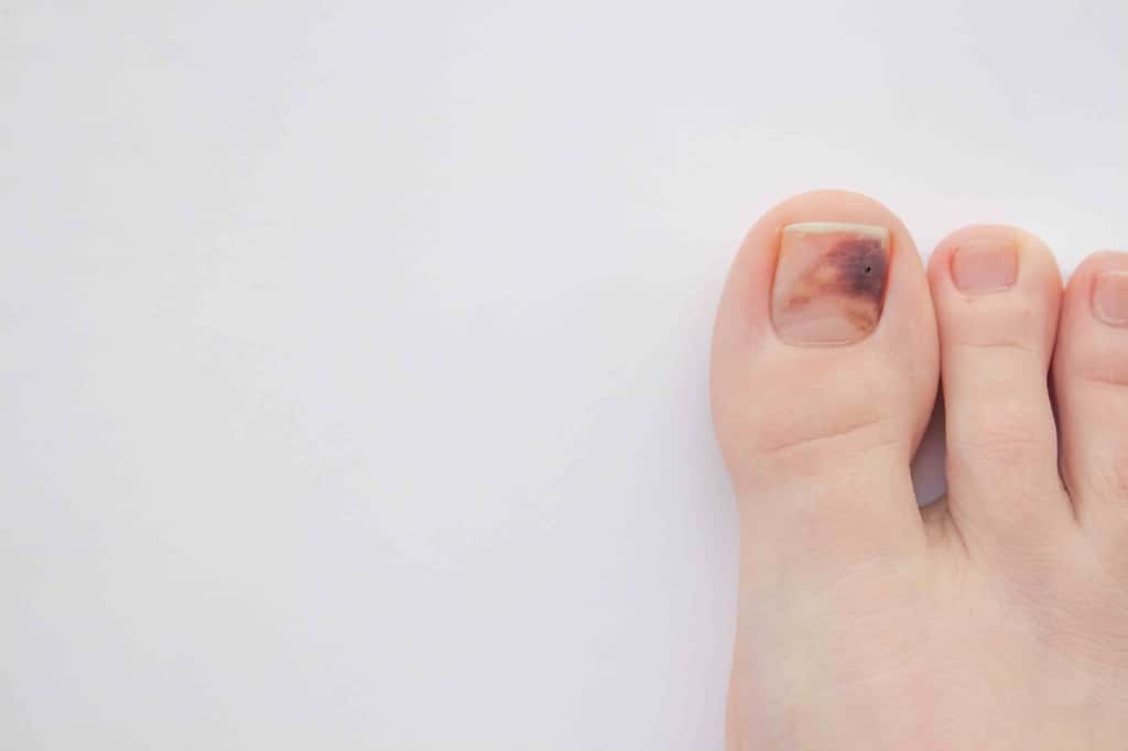Les traumatismes des ongles sont plus fréquents sur ceux des orteils sur ceux des doigts. © TheWonderWays, Shutterstock