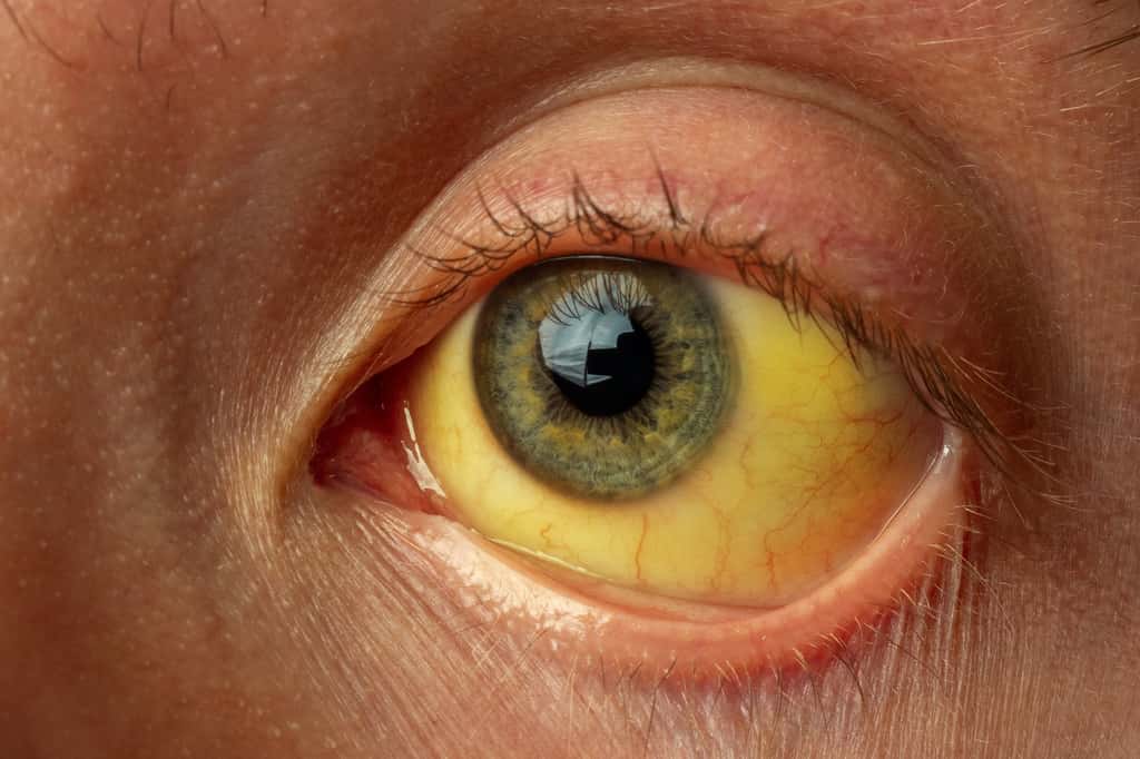 Le blanc des yeux qui devient jaune est le signe d'une jaunisse (ou ictère) et d'un trouble du fonctionnement du foie. © daniiD, Adobe Stock