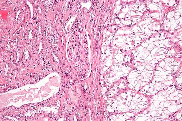 Parenchyme rénal montrant à droite des cellules claires tumorales. © Néphron, Wikipédia Commons, CC by-sa 3.0