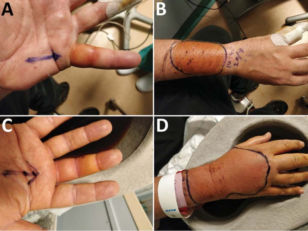 La main et l'avant-bras infectés du patient britannique. A : son auriculaire gauche ; B : son avant-bras droit ; C : son majeur droit, et D : sa main droite. © Jones et <em>al., Emerging Infectious Diseases</em>, 2023