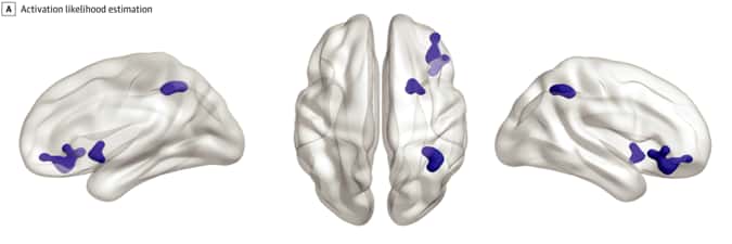 La cartographie des zones cérébrales sous-activées chez les personnes anxieuses ou dépressives. © Janiri et <em>al.</em>