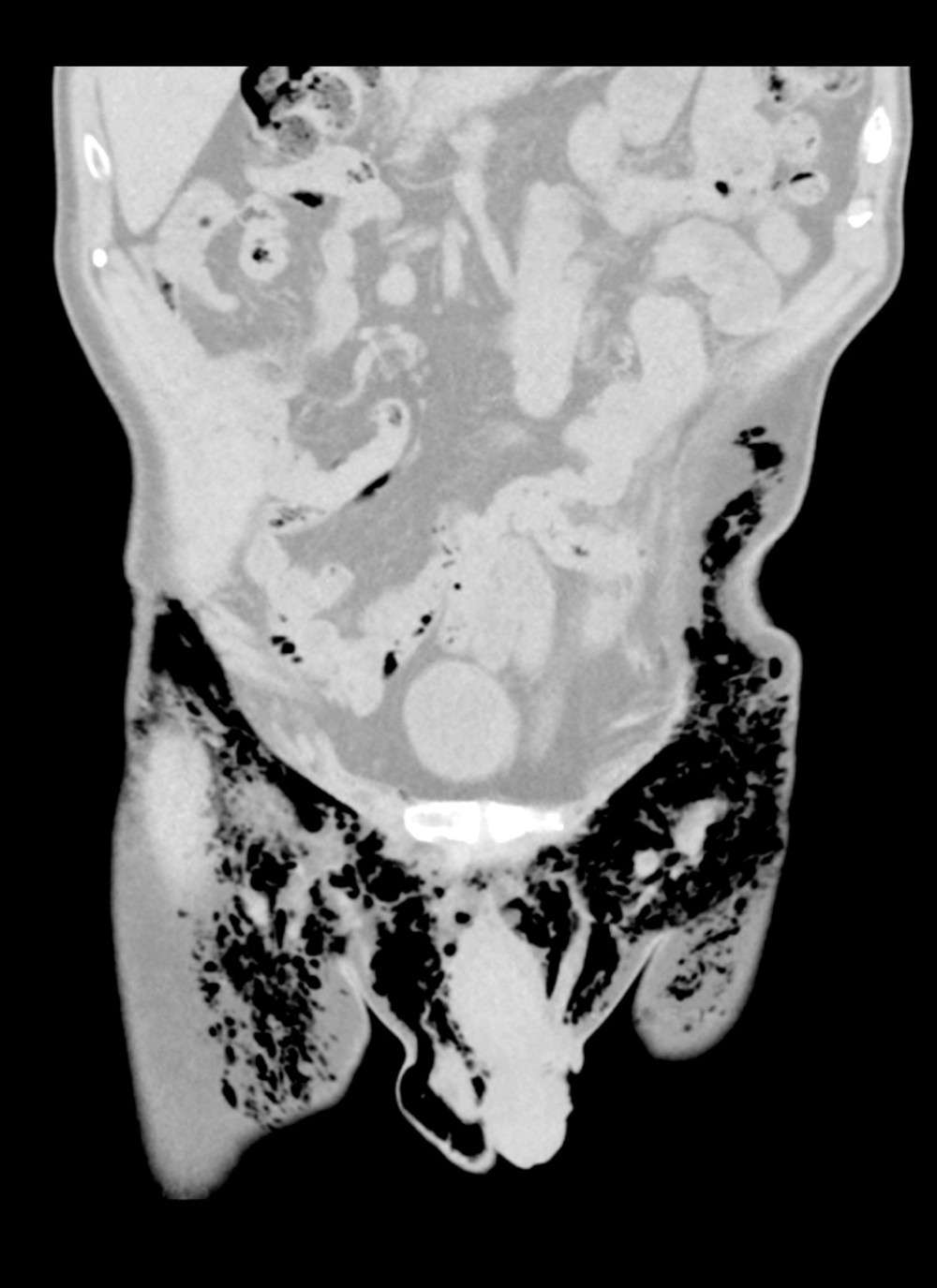 Image au scanner du scrotum sifflant. © Brant Bickford et <em>al. American Journal of Case Reports</em>