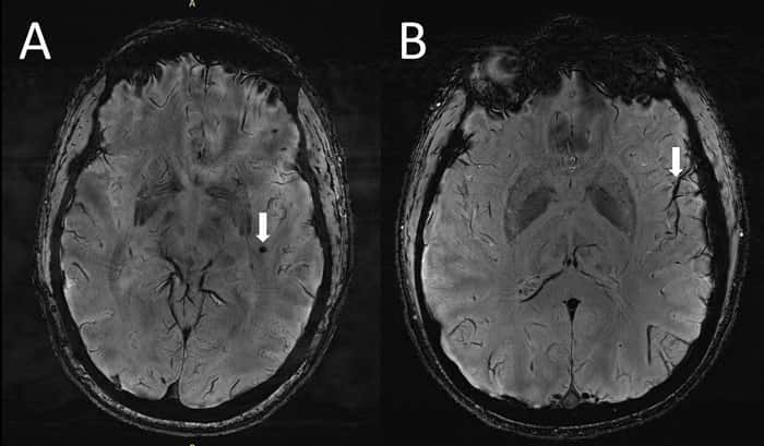 L'imagerie cérébrale a révélé des caractéristiques distinctes dans le cerveau des migraineux, représentées ici par des micro-saignements cérébraux (à gauche) et des espaces périvasculaires élargis (à droite). © RSNA and Wilson Xu