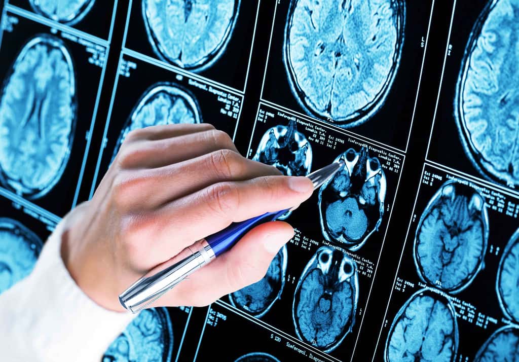 Des signes d'Alzheimer sont observables sur les images IRM du cerveau. © BillionsPhotos, Adobe Stock