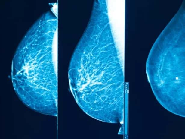 Avec plus de 60 000 nouveaux cas chaque année en France, le cancer du sein reste le premier cancer féminin et la première cause de mortalité par cancer chez les femmes, avec 12 000 décès par an. À l’occasion d’Octobre rose, l’Institut Curie fait le point sur les innovations en imagerie médicale. © Institut Curie