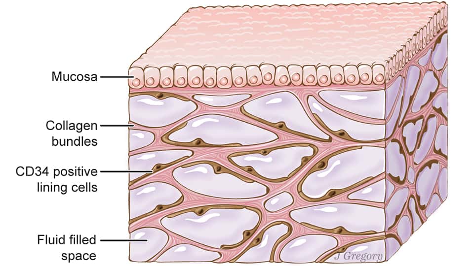 L'interstitium, ici sous une muqueuse (<em>mucosa</em>), comprend des compartiments interconnectés, emplis de liquide, soutenus par un réseau de protéines (<em>collagen</em>). Des cellules tapissent les espaces. © Jill Gregory, <em>Scientific Reports</em>