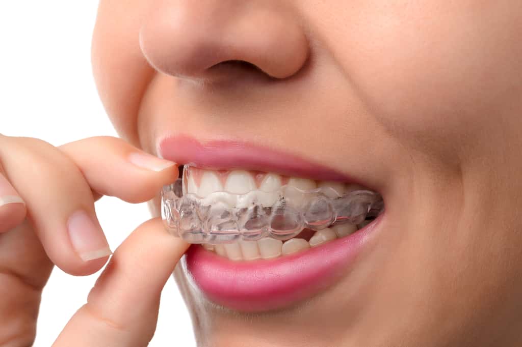 Les appareils dentaires invisibles sont des gouttières transparentes très discrètes et confortables. © pavelsm27