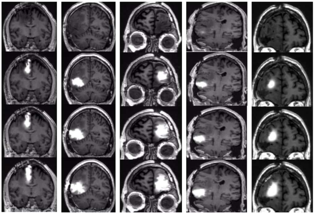 Les scanners cérébraux de cinq patients (de haut en bas) réalisés avant le traitement, puis 14, 24 et 48 heures après, révèlent la concentration du médicament de chimiothérapie autour de leurs tumeurs. © Jeffrey Bruce, <em>Columbia University Irving Medical Center</em>