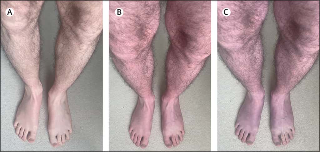 Les jambes du patient à 0 minute (A), 2 minutes (B) et 10 minutes (C) après s'être levé. © Nafi Iftekhar et Manoj Sivan,<em> The Lancet</em> 