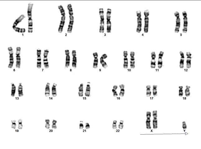 Le caryotype d'un individu atteint du syndrome de Klinefelter présente la plupart du temps un chromosome sexuel X surnuméraire, soit 47 chromosomes au total. © Valdes Socin et al, 2019