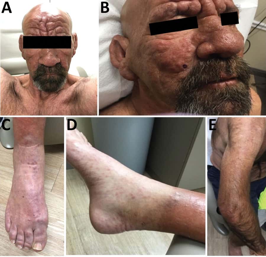 Les lépromes diffus et douloureux sur le corps d'un homme de 54 ans habitant en Floride. © Aashni Bhukhan, Charles Dunn et Rajiv Nathoo, <em>Emerging Infectious Disease</em>