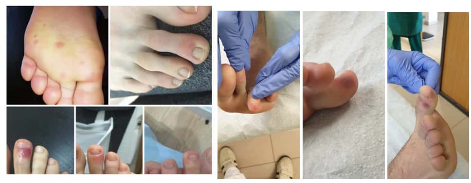 Exemple des lésions aux pieds liées à des cas de Covid-19 avérés. © Conseil des Podiatres d'Espagne