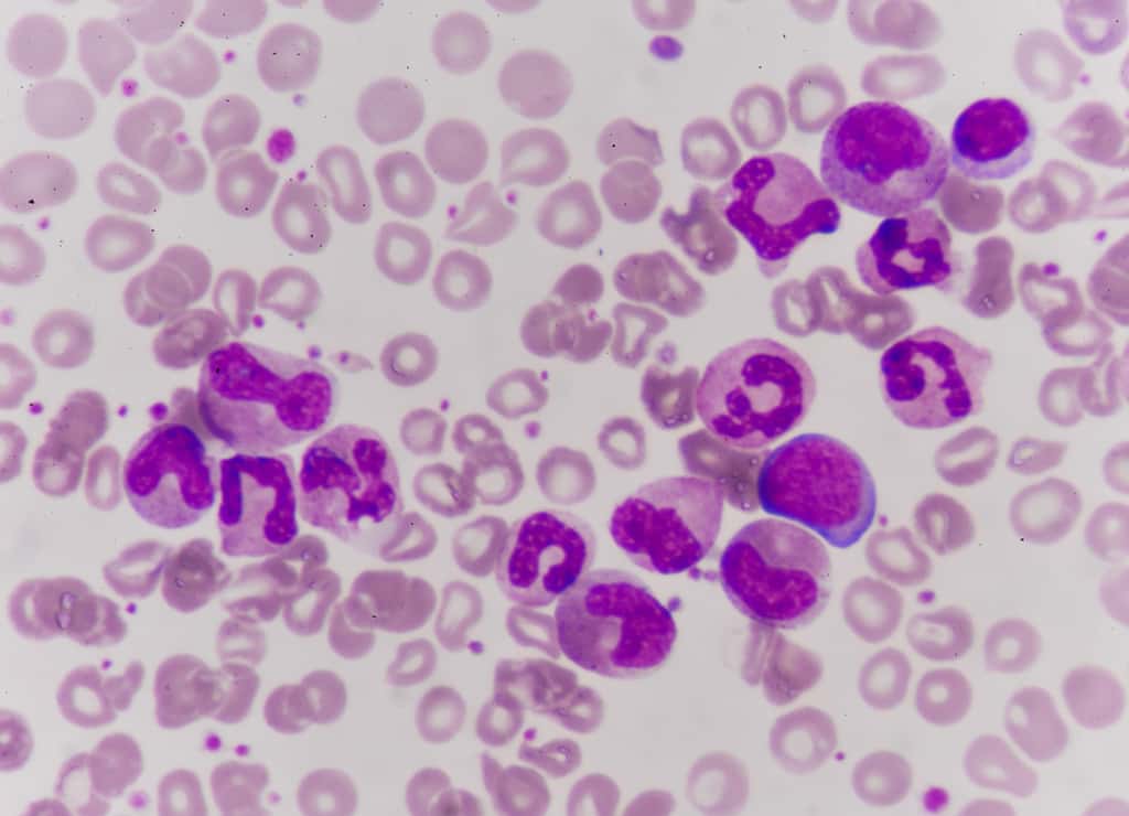 La leucémie aiguë myéloïde est un cancer de la moelle osseuse lié à la prolifération anormale de cellules précurseurs des globules blancs. © toeytoey, Fotolia