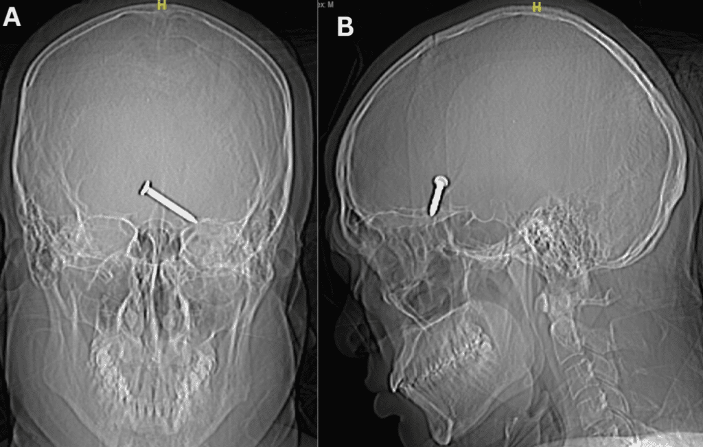 Radiographie simple du crâne, vues antéropostérieure (A) et latérale (B), montrant un corps étranger métallique ressemblant à un clou. © Cureus