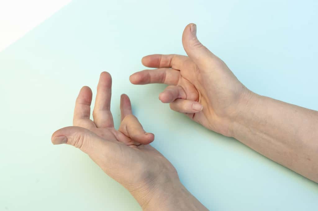 Les mains en griffe caractéristique d'une patiente atteinte de la maladie de Dupuytren. © Elena Shi, Adobe Stock