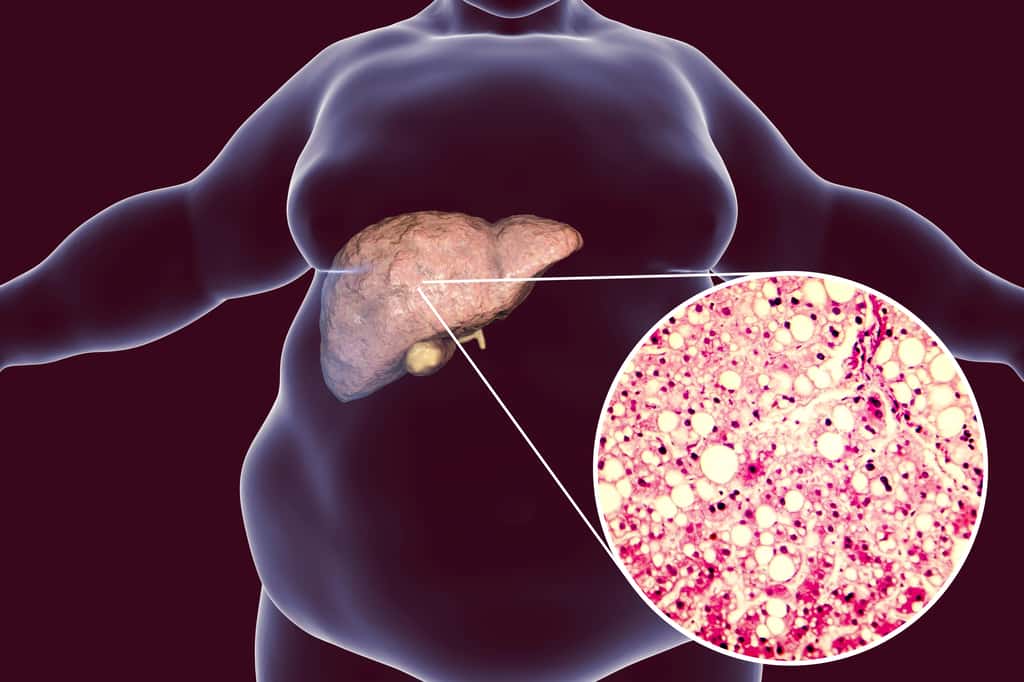 Stéatose du foie chez un homme obèse. © Kateryna_Kon, Adobe Stock