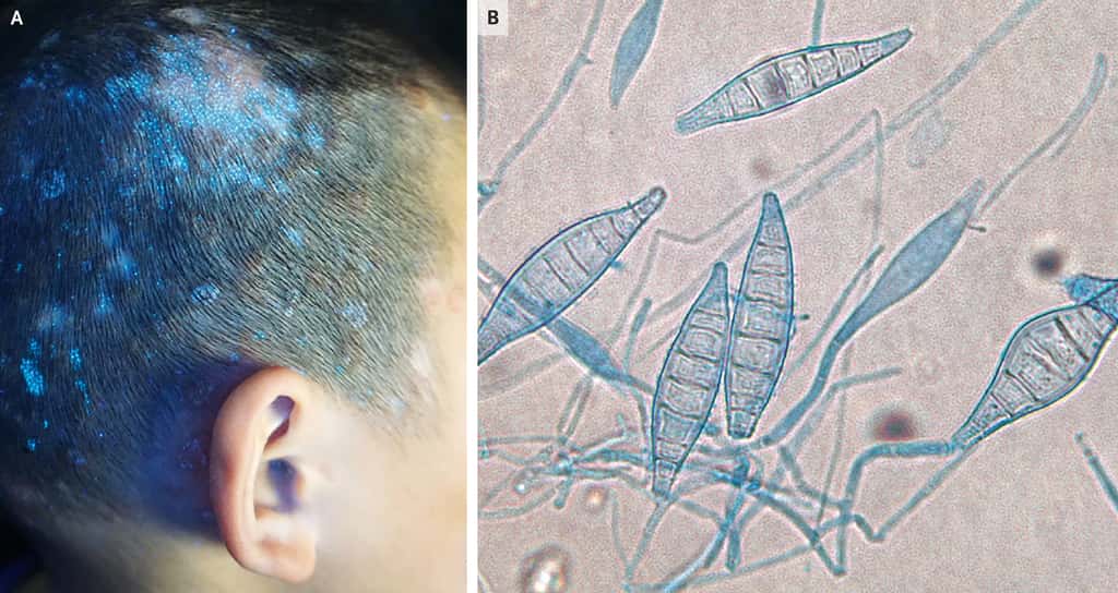 À gauche, les boutons bleus sur le cuir chevelu de l'enfant et à droite, le champignon microscopique responsable de son état. © Tingting Wang et <em>al. NEJM</em>