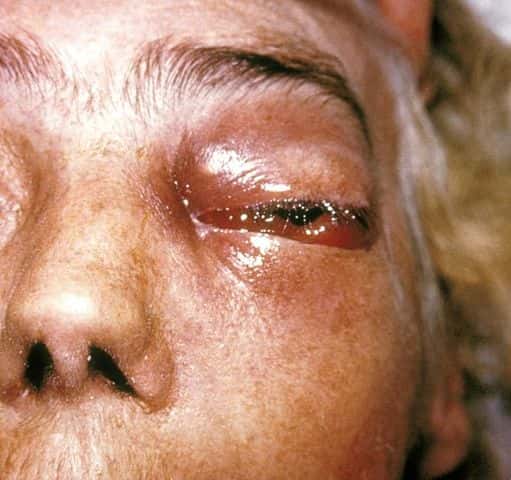 Un œil nécrosé à cause d'une mucormycose. © Domaine public