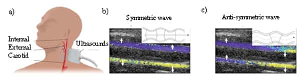 L’onde de pouls la plus connue (onde de dilatation) est due à l’écartement des parois vers l’extérieur de façon symétrique par rapport à l’axe central de l’artère, sous l’effet de l’afflux sanguin. Et l’onde de flexion, nouvellement découverte, est due à une torsion de l’artère d’un côté puis d’un autre de cet axe. © Stefan Catheline