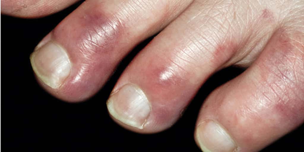 Certains patients avec une Covid-19 longue ont des engelures aux orteils et aux mains, parmi d'autres manifestations dermatologiques. © CC