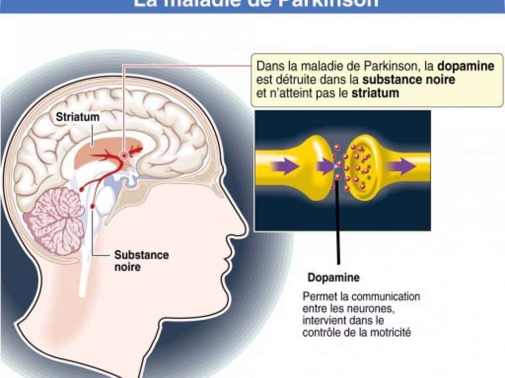 Schéma simplifié de la maladie de Parkinson. © AFP.com, J Hollier, Larousse
