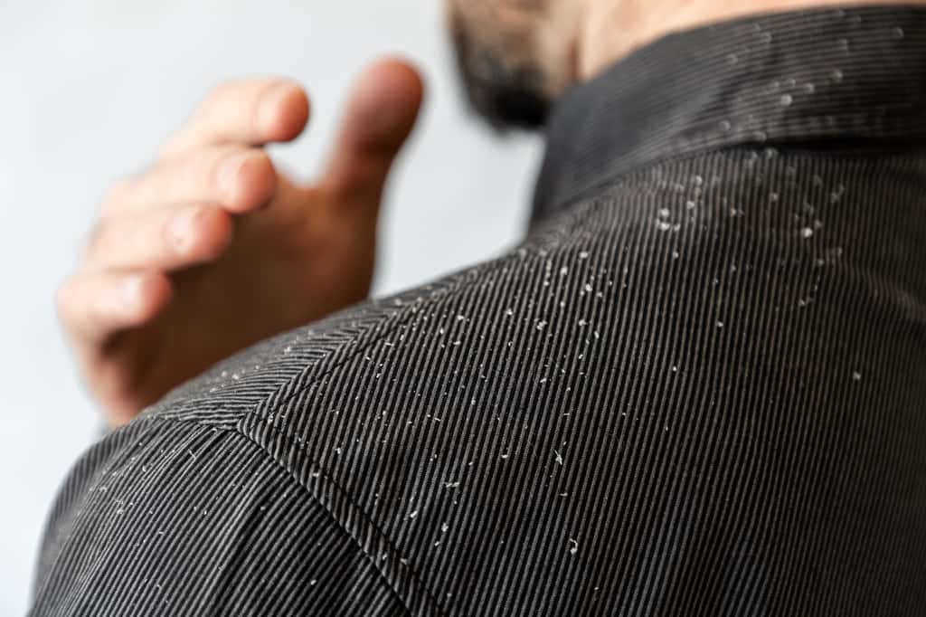 À la différence des lentes, les pellicules se détachent du cuir chevelu et tombent souvent sur les épaules. © KUBE, Adobe Stock