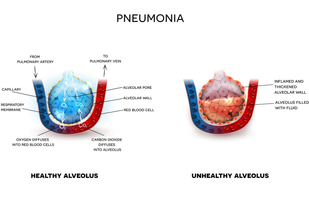 Pneumonie : les alvéoles pulmonaires se remplissent de liquide inflammatoire. © Reineg, Adobe Stock