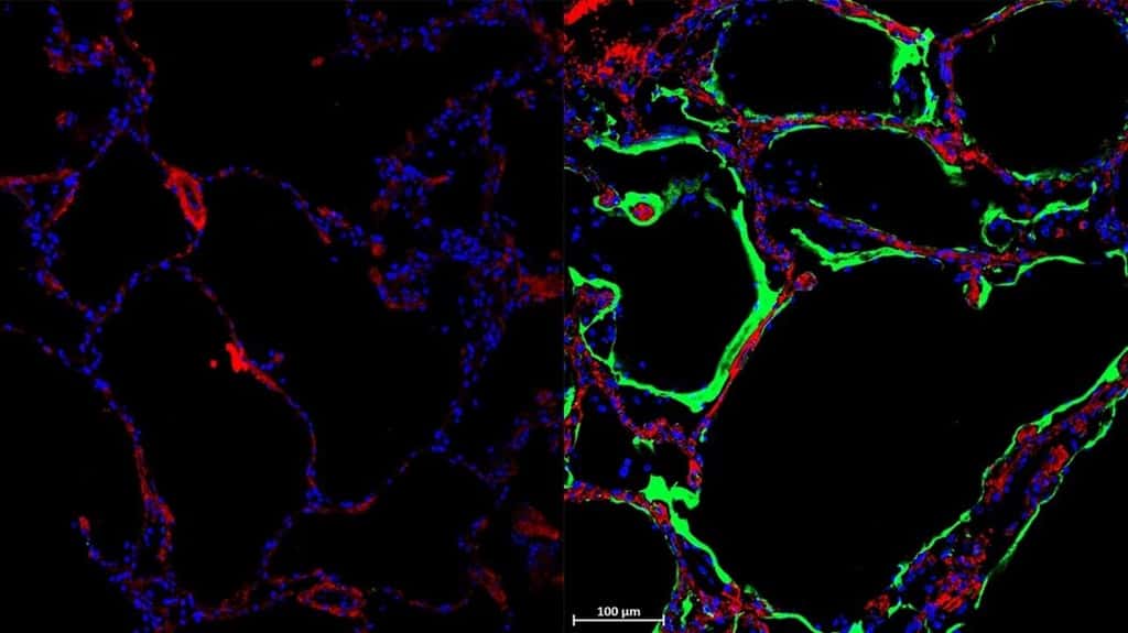 À gauche : poumon témoin. À droite : la coloration immunofluorescente montre l'expression du nouveau récepteur LRRC15 du SARS-CoV-2 (vert) dans une coupe de tissu pulmonaire post-mortem d'un individu atteint de Covid-19. © <em>The University of Sydney</em>